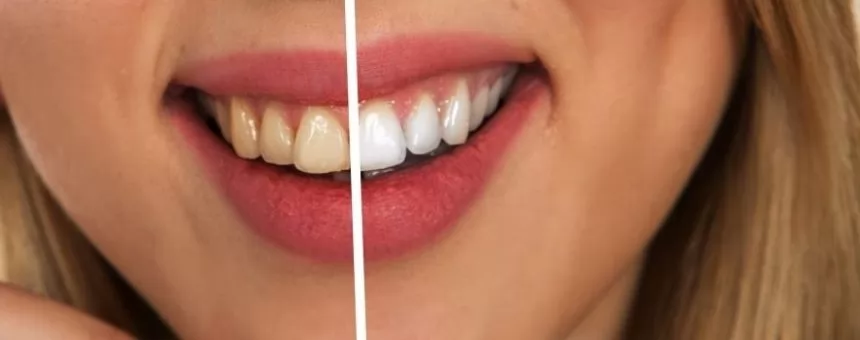 Diş beyazlatma işleminin zararları var mıdır?